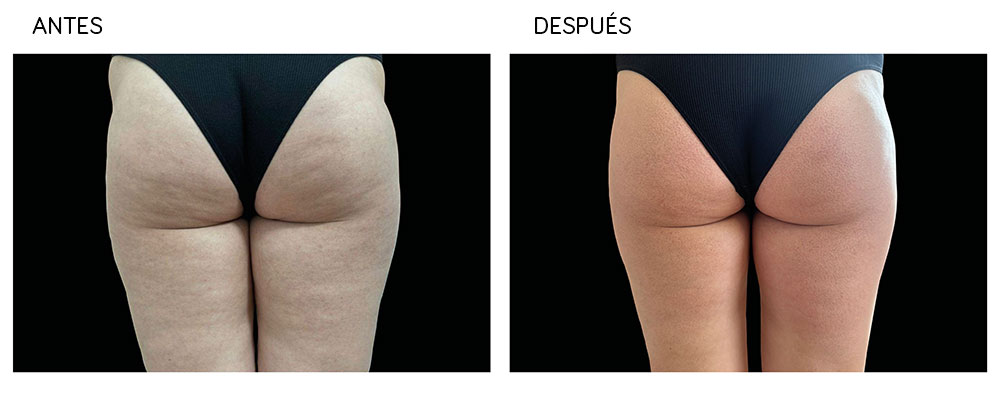 Imagen antes y después de tratamiento con radiofrecuencia corporal sobre glúteos y muslos Tratamientos con radiofrecuencia para medicina estética