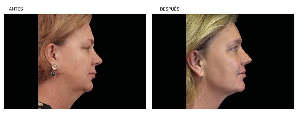 Imagen antes y después de tratamiento de radiofrecuencia facial en mentón Tratamientos con radiofrecuencia para medicina estética