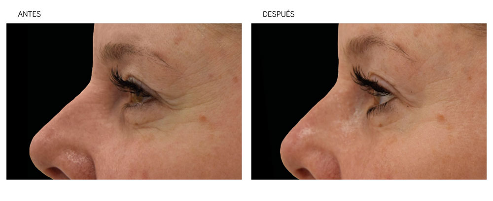Imagen antes y después de tratamiento de radiofrencuencia facial en párpados Tratamientos con radiofrecuencia para medicina estética