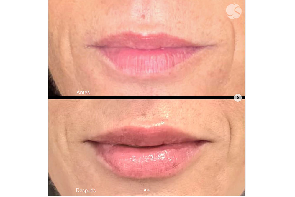 Hidratación de labios Hidratación de labios